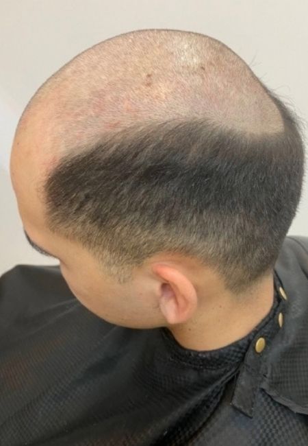 Mens Before Superior Hair Extensions Transformation